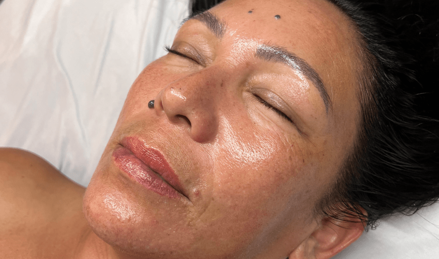 DERMAPLANING